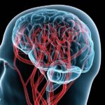 Инсульт, также называемый мозговым инсультом, является серьезным заболеванием, которое возникает в результате нарушения кровоснабжения мозга. Это может произойти из-за разрыва сосуда в мозге (геморрагический инсульт) или из-за забивания сосуда (исхемический инсульт).