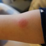 Дети могут спокойно мочить пробу Манту, так как это не повлияет на результаты теста. Однако, чтобы избежать возможных ложноположительных результатов, следует соблюдать следующие рекомендации: