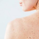 Родинки (меланочные невусы) обычно появляются из-за избыточного накопления пигмента в коже. Этот пигмент называется меланином, и он отвечает за цвет кожи, волос и глаз. Родинки обычно имеют коричневый или черный цвет и могут быть плоскими или выпуклыми.